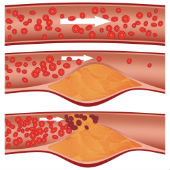 Последствия, симптомы и диагностика атеросклероза