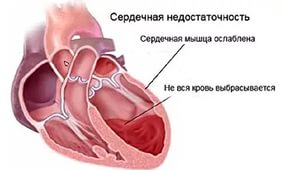 Симптомы и причины сердечной недостаточности