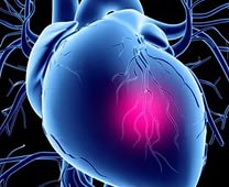 Причины, диагностика и лечение стенокардии